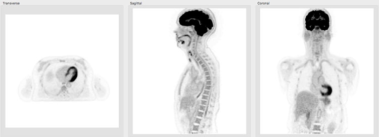 Physics Instrumentation Group PennPET Explorer scan 1.5hr post-injection 